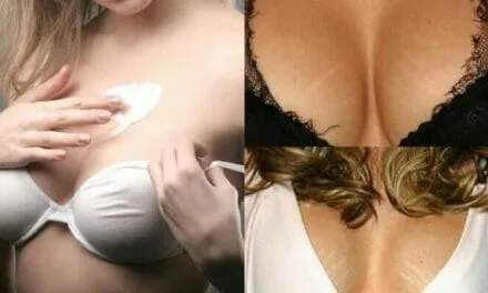 Estrías en los Senos, Porqué Aparecen y Cómo Quitarlas [Videos]