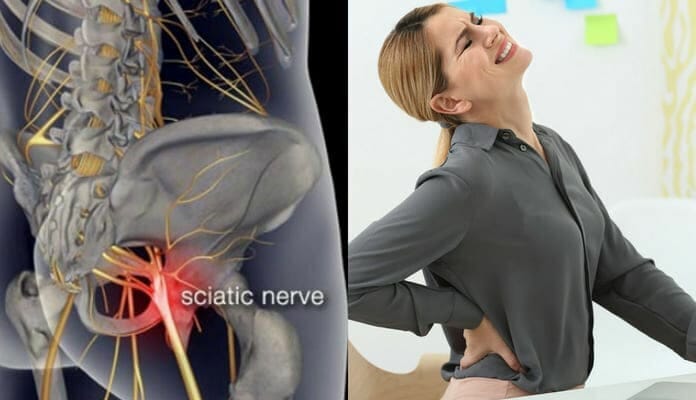 Como Curar el Nervio Ciático y el Dolor de Espalda Baja, Cadera y Pierna
