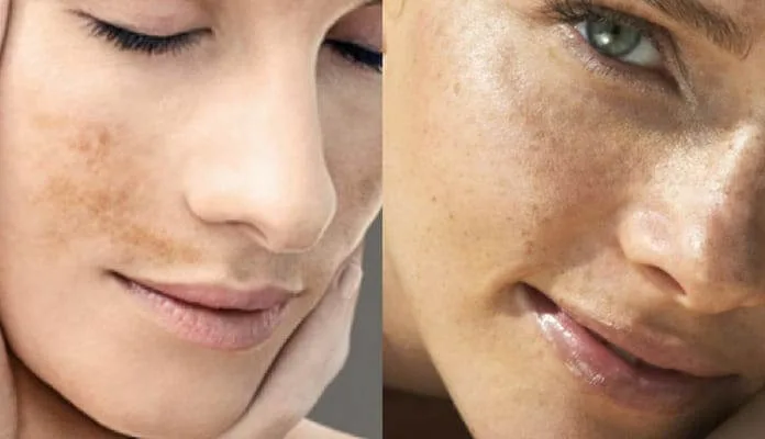 12 Tratamientos Naturales Para Quitar las Manchas de Paño o Melasma