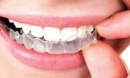 Cómo Conseguir tu Sonrisa Ideal con Invisalign, Ventajas de la Ortodoncia Invisible sin Brackets
